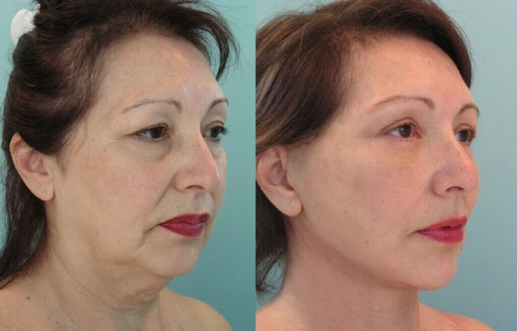 תמונה לפני ואחרי התחדשות העור